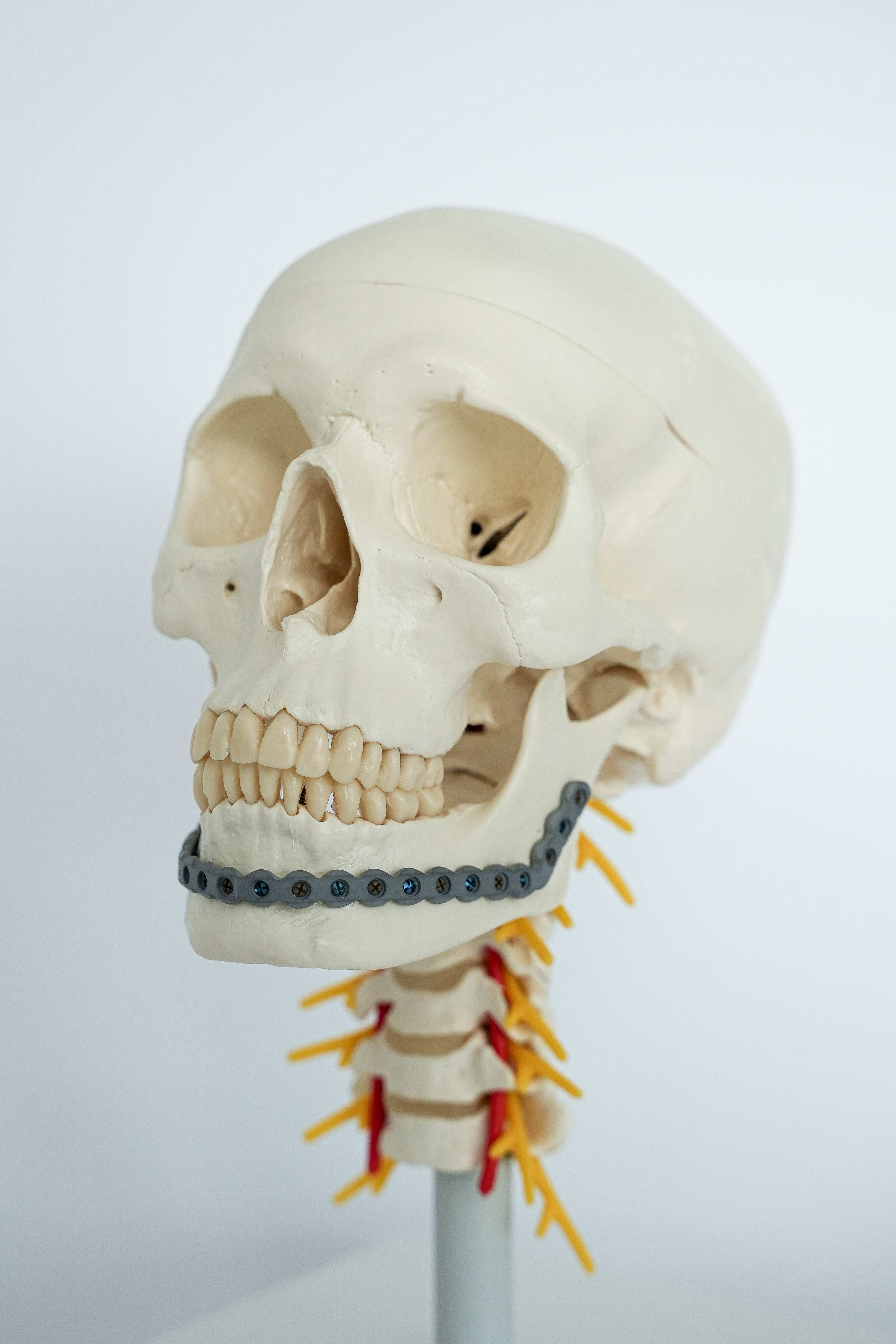 Osteosynthese-Implantat für einen Unterkiefer