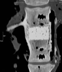X-ray Image Vertebral Body