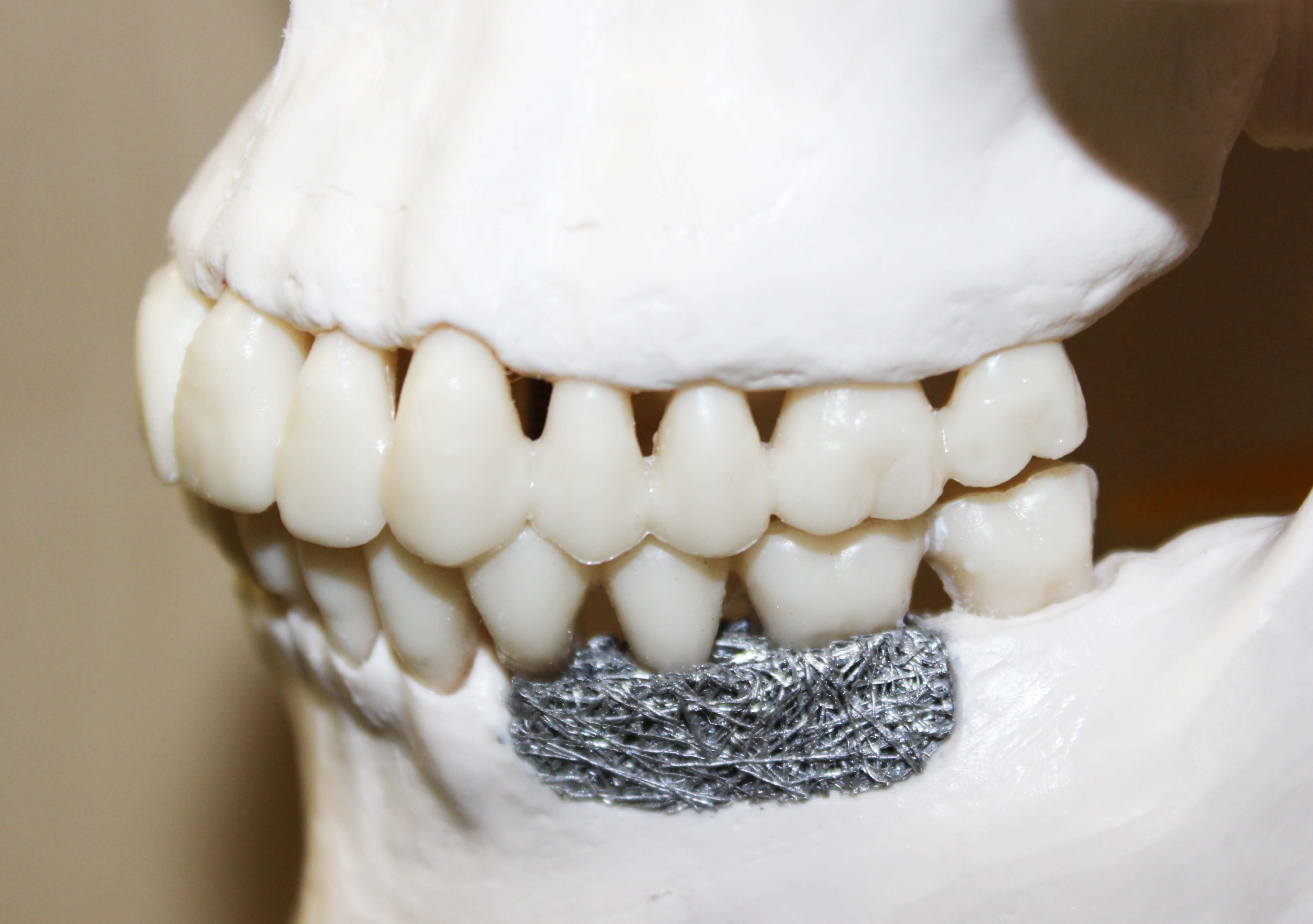 Example of a Magnesium Implant in Oral Surgery (Model)