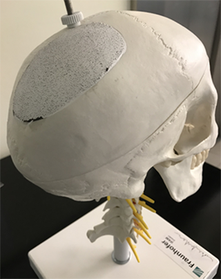 Model of a Skull Cap Implant