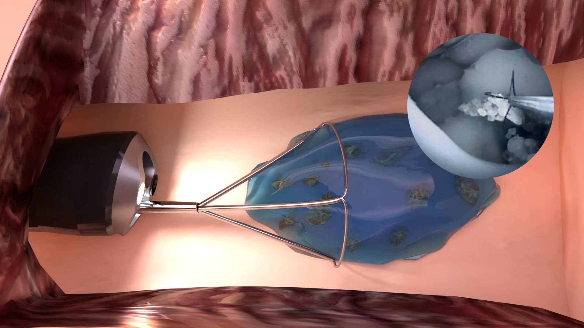 Greifen und Entfernen der in »mediNiK®« eingebetteten Nierensteinfragmente. Große Darstellung: Animation der eingebetteten Nierensteinfragmente. Kleine Darstellung im Kreis rechts oben: Sicht des operierenden Urologen durch die Kamera des Endoskops.
