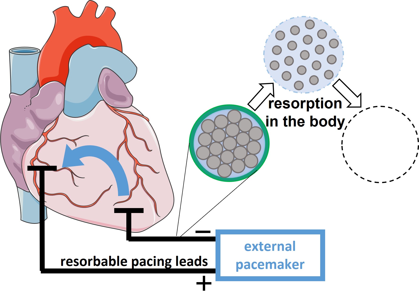 resorbable pacing leads